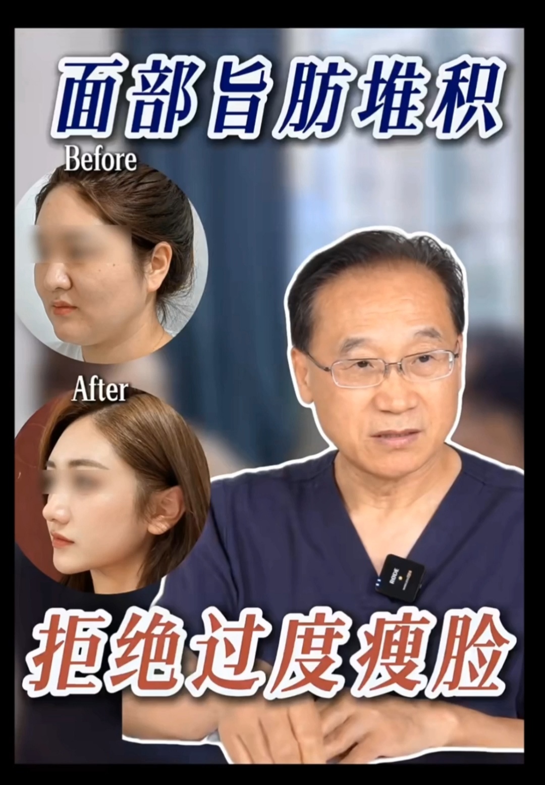 面部脂肪堆积？拒绝过度瘦脸
