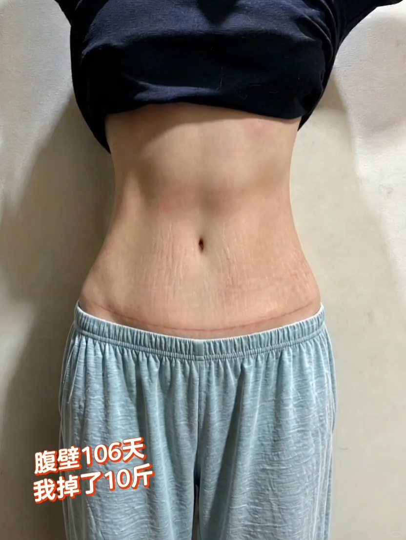 腹壁成型术后106天