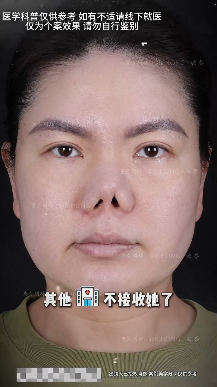 鼻子挛缩成这样三年未摘口罩