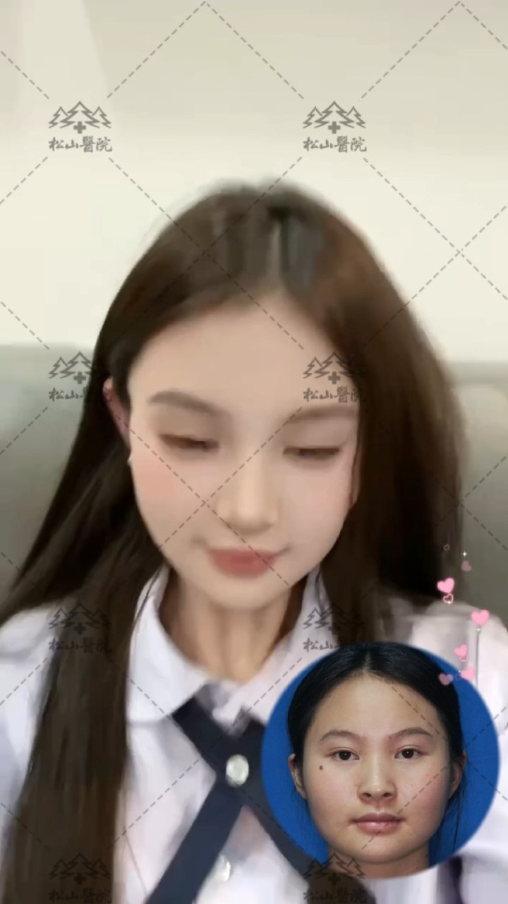 轮廓术后大变样