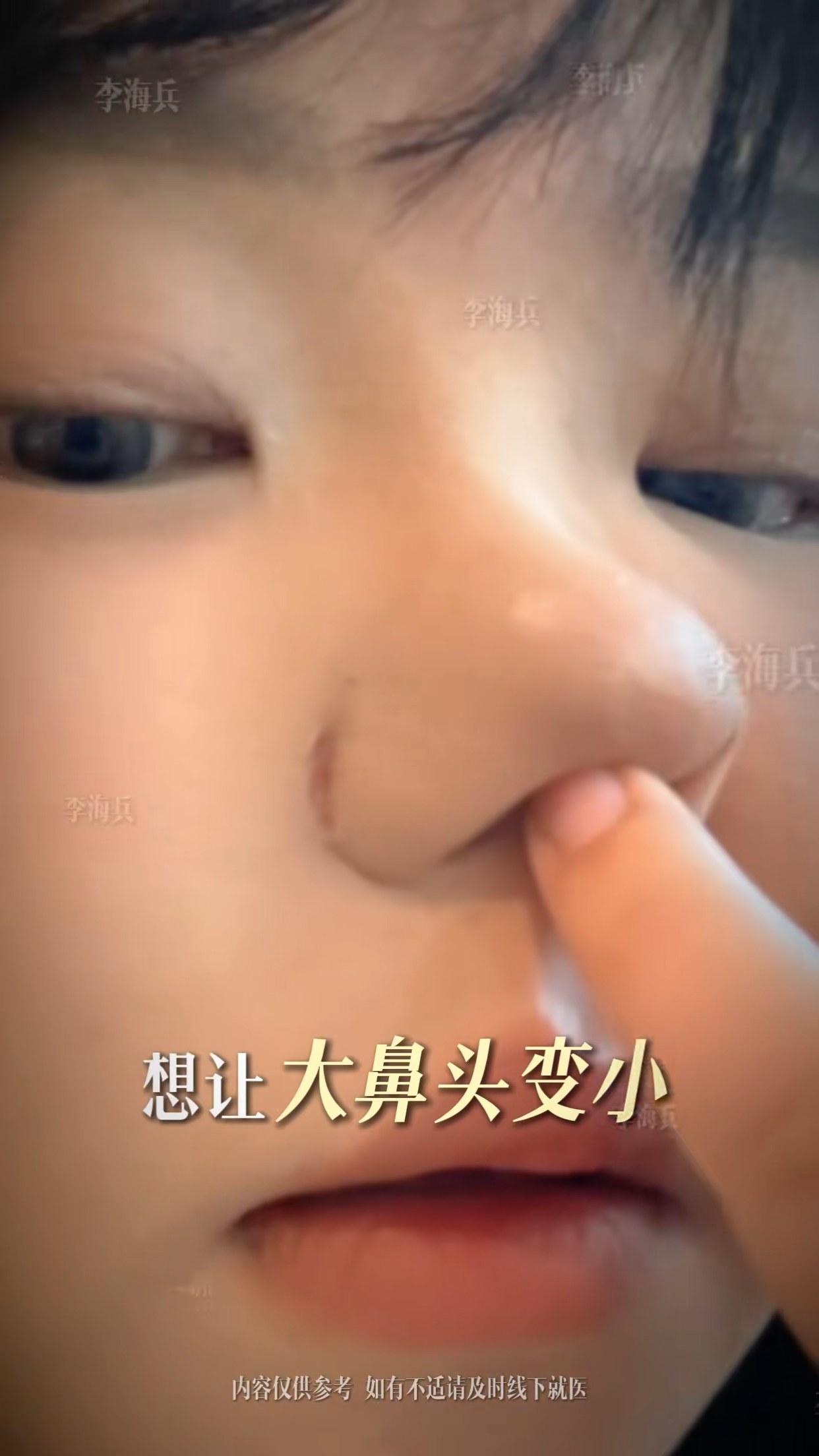 想让大鼻头缩小又不想留疤的一定要看