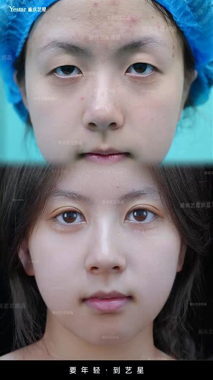 精细化眼综合塑形