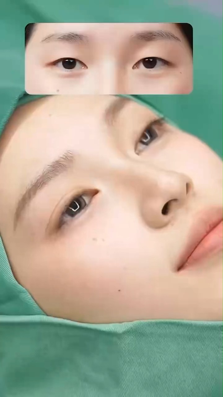 好漂亮的双眼皮