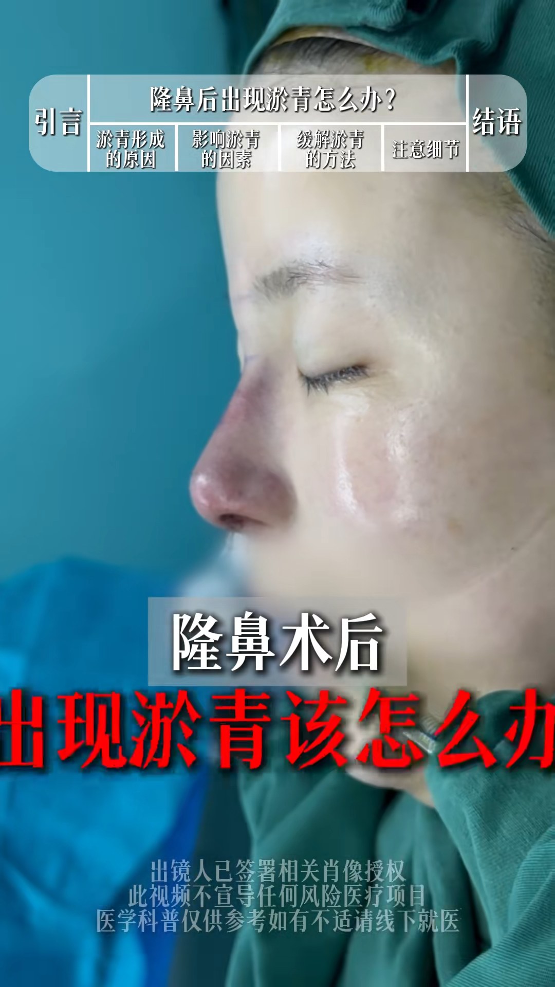 隆鼻术后出现淤青怎么办？多久能消失？