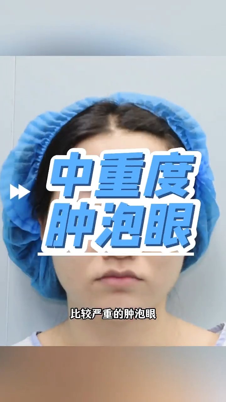 怎么让肿泡眼消失