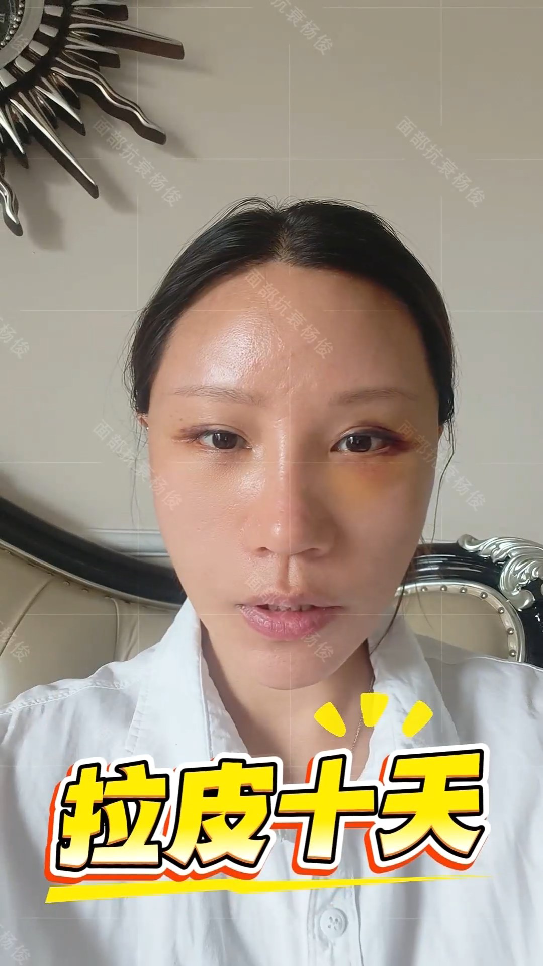 DGS四维青春复原术术后十天