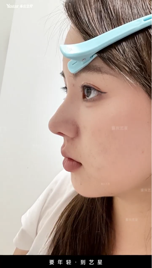 术后3个月恢复反馈