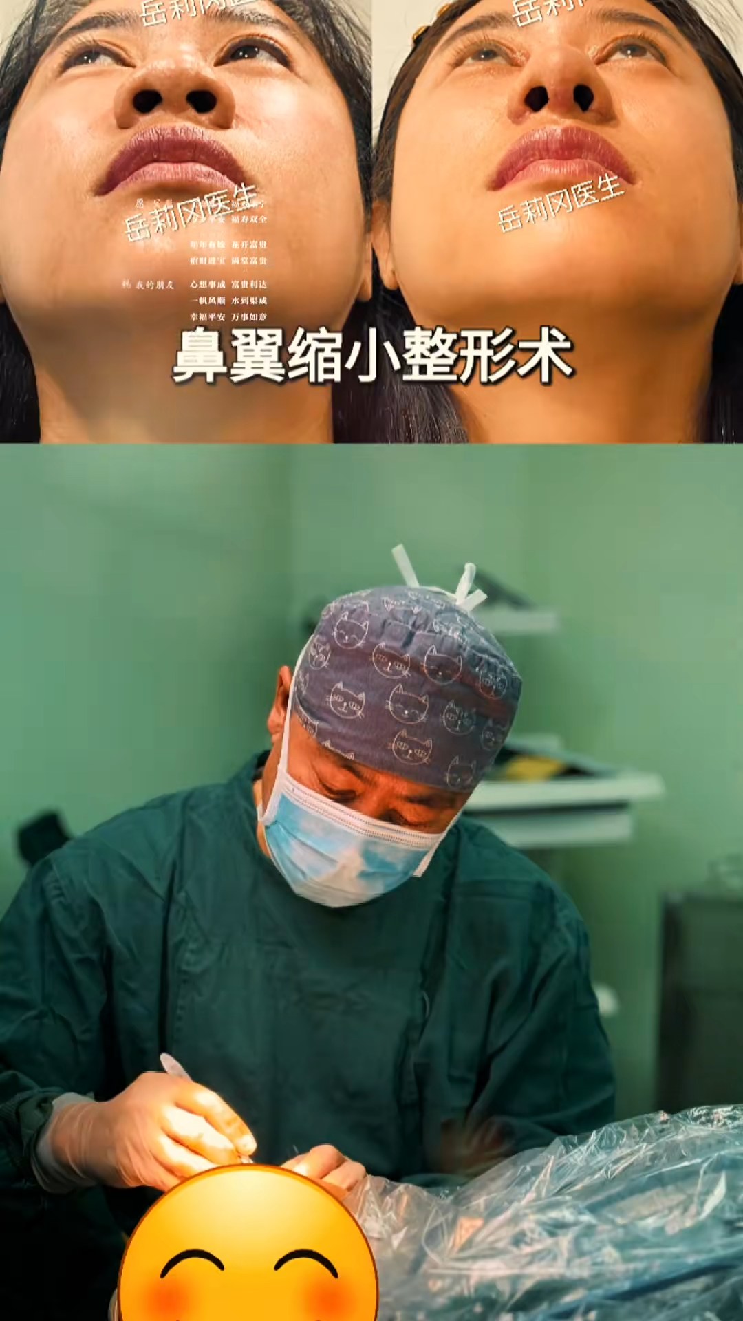 鼻翼缩小