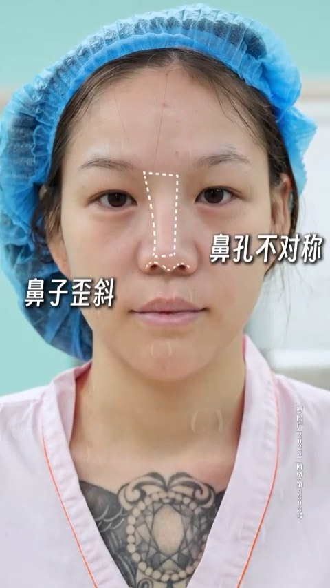 鼻修复｜解锁上镜妈生鼻🌿