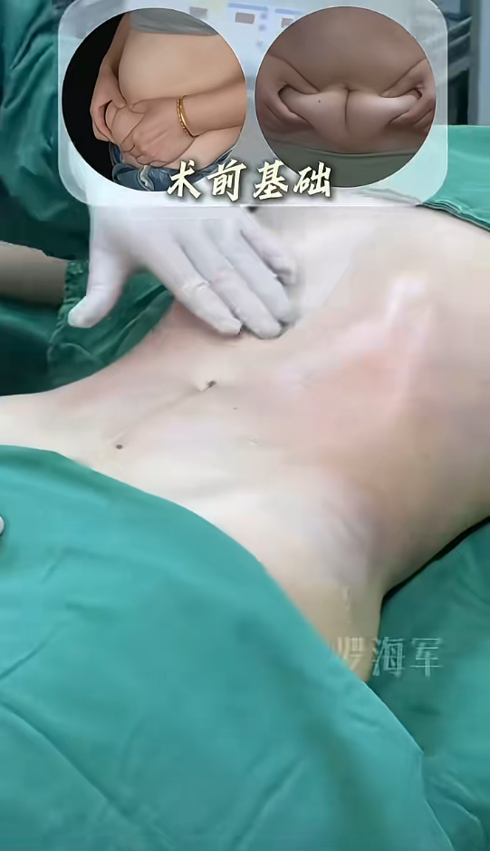 腰腹吸脂打造