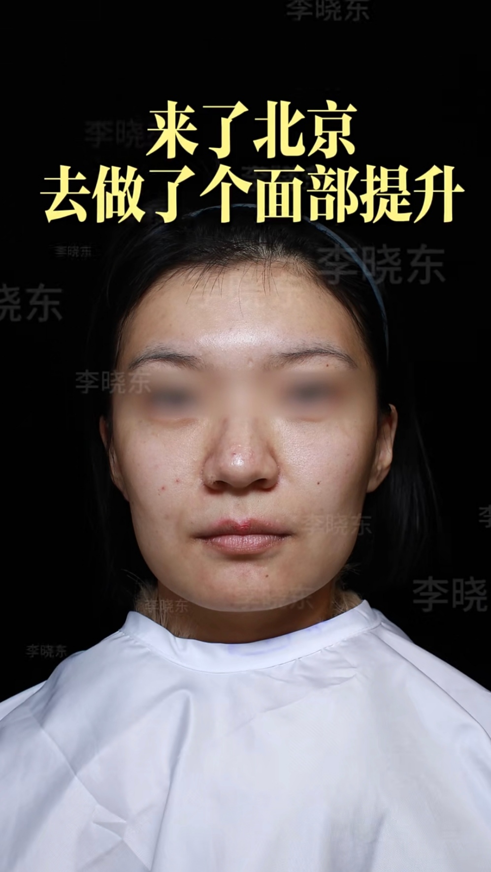 39岁做了面部提升 有什么变化？