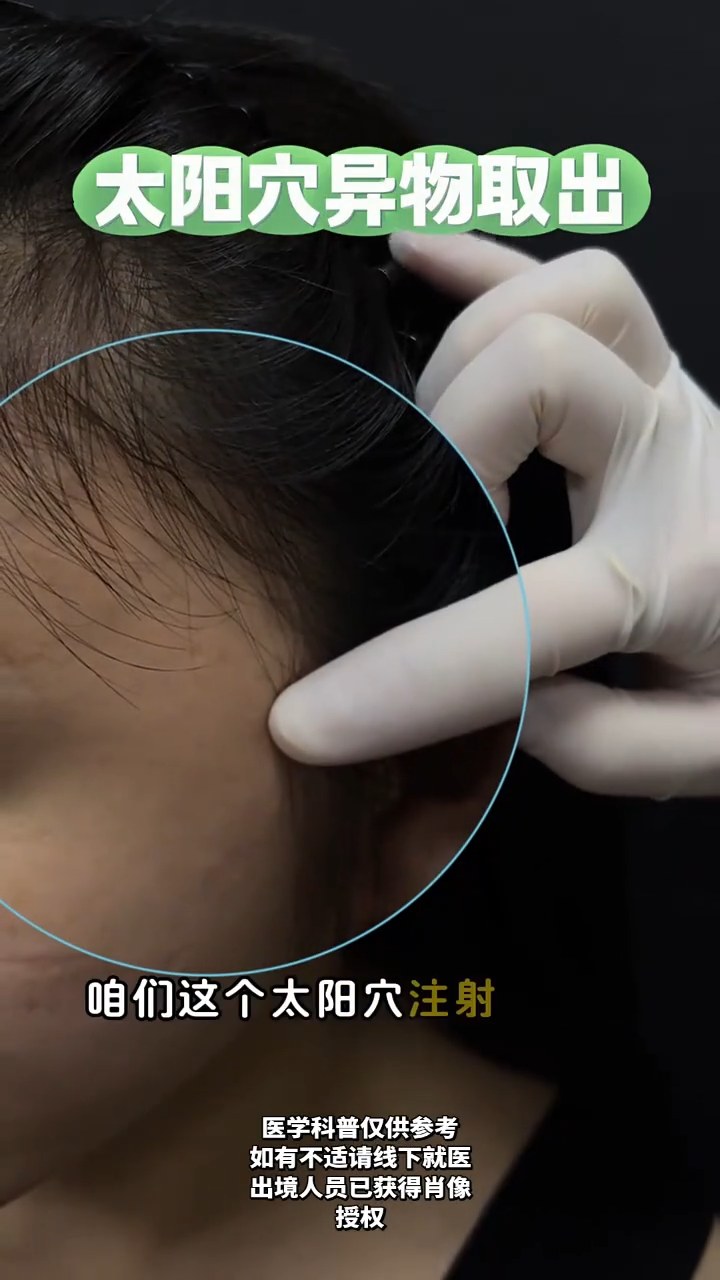 太阳穴异物取出 类似生长因子
