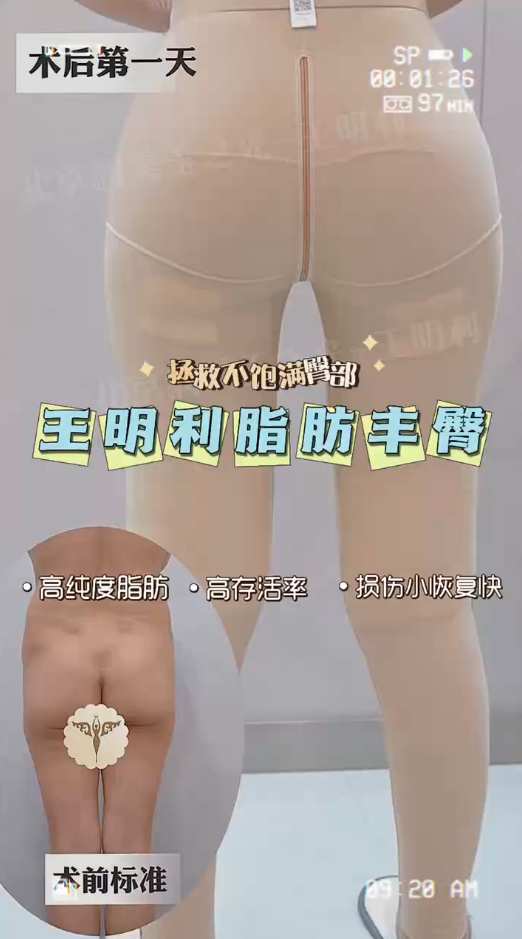 王博士丰臀真实案例