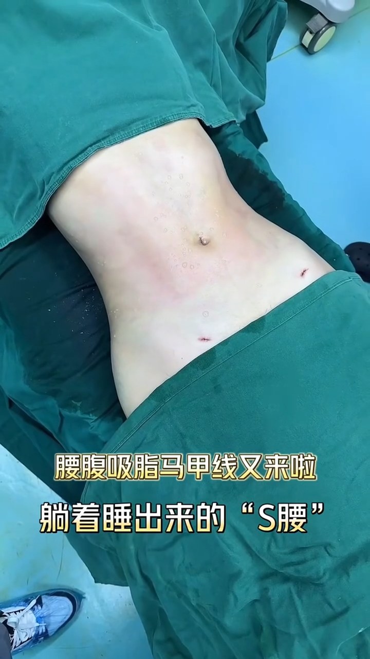 手术台即刻效果及术后S腰曲线展示