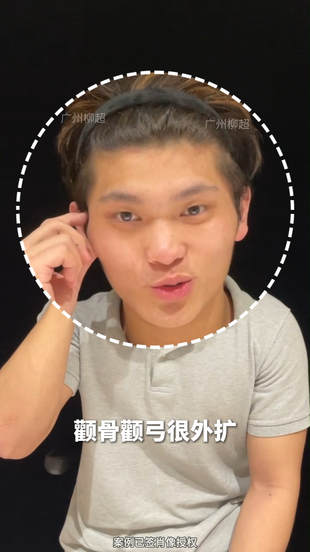 术后拥有妈生感轮廓✨