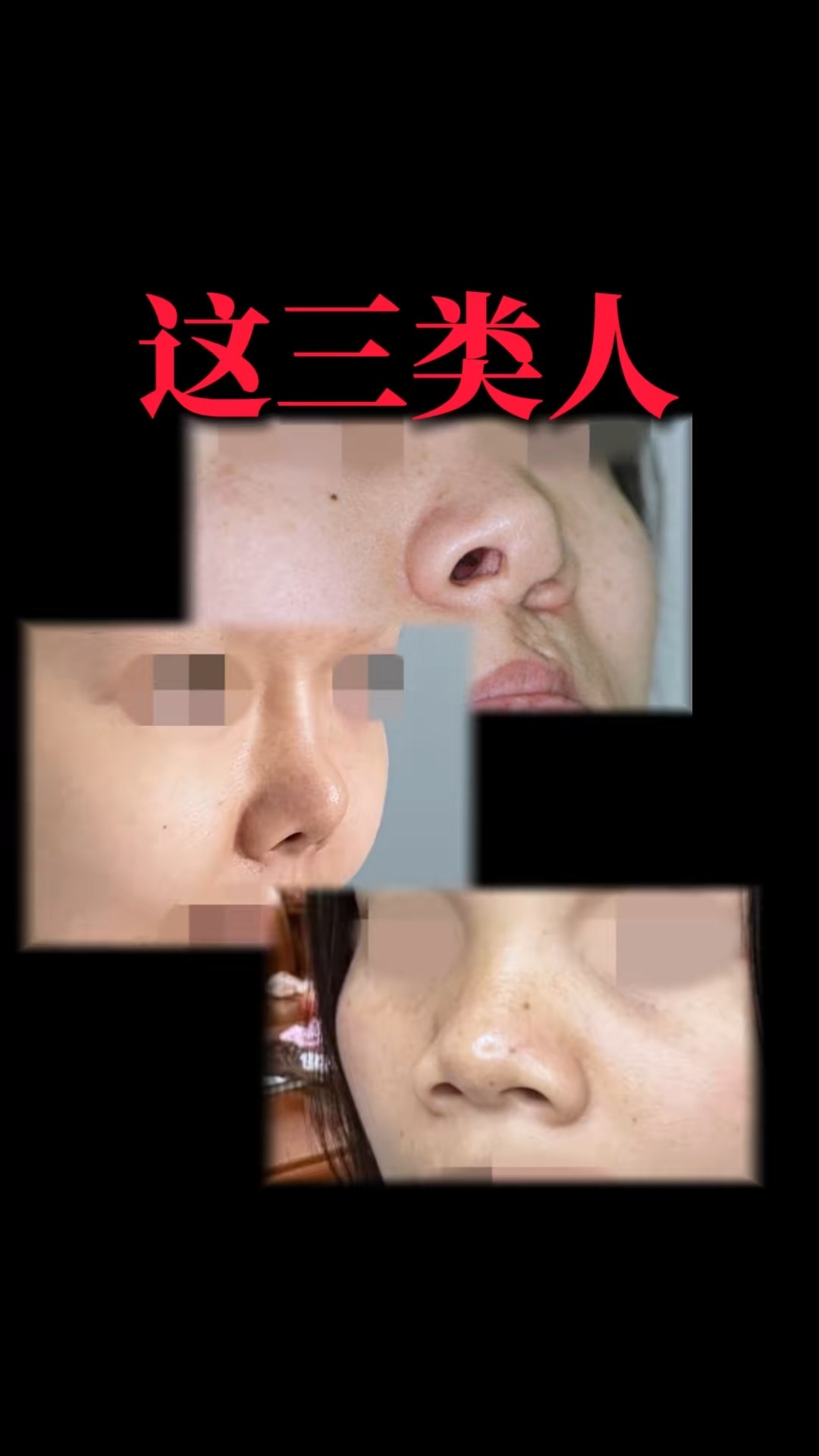 这三类人不适合做耳软骨隆鼻