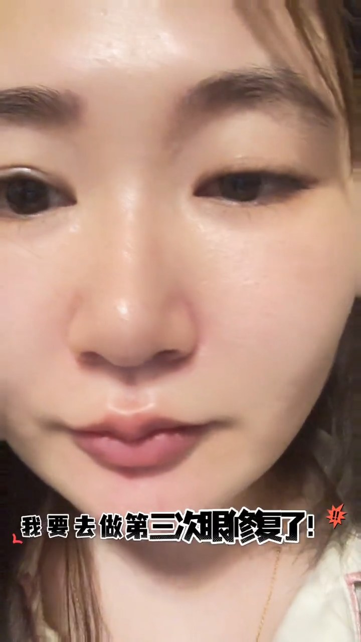 上睑下垂提肌过度？希望是最后一次的眼修复