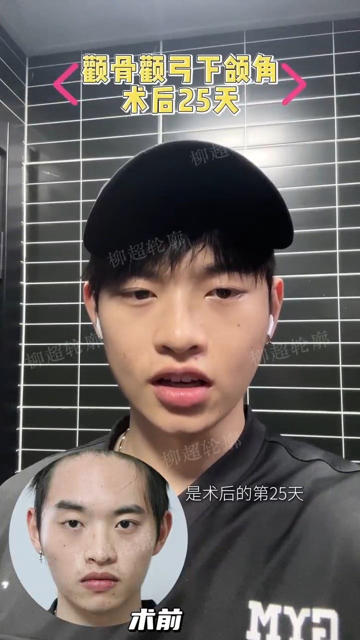 男士颌面轮廓｜术后 25 天✅