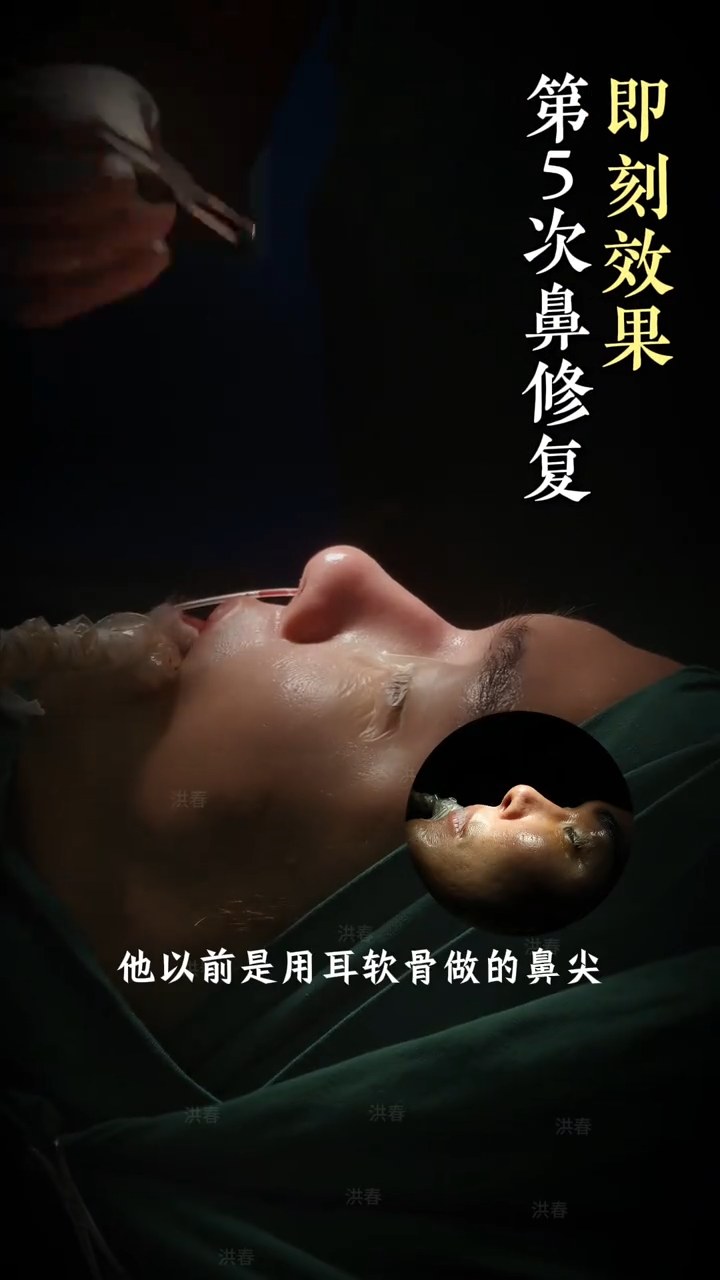 反复修复怎么办？带你了解五次修复的鼻子