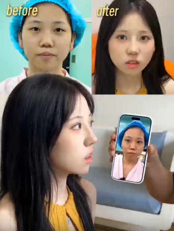 膨体肋骨鼻｜妈生直鼻微翘👃