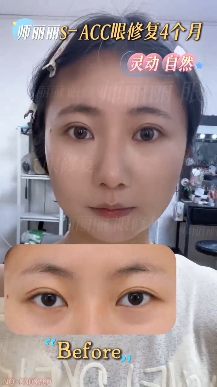 眼修复4个月👉清甜幼态小开扇