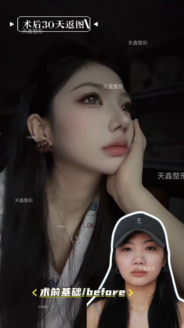 顾客返图｜鼻翼鼻梁变高了‼️