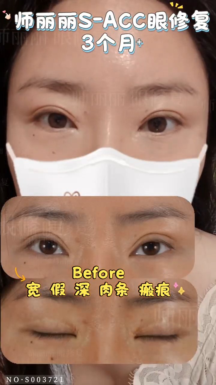 眼修复 3 个月⁺