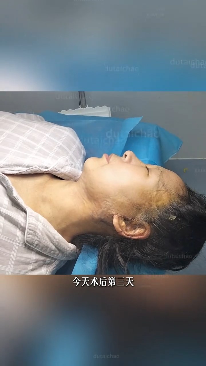 拉皮术后第3天，疼痛真实感受