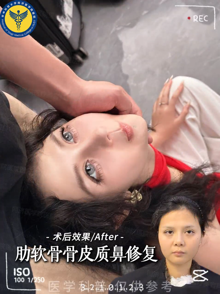 肋软骨骨皮质鼻修复