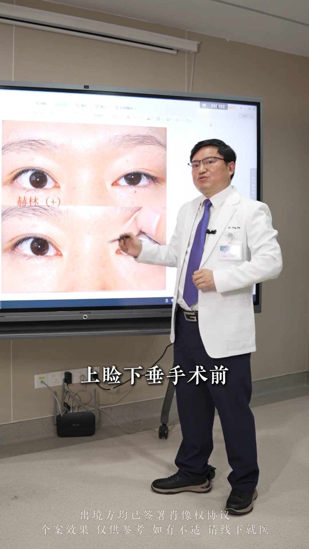 上睑下垂术前常规检查—赫林现象