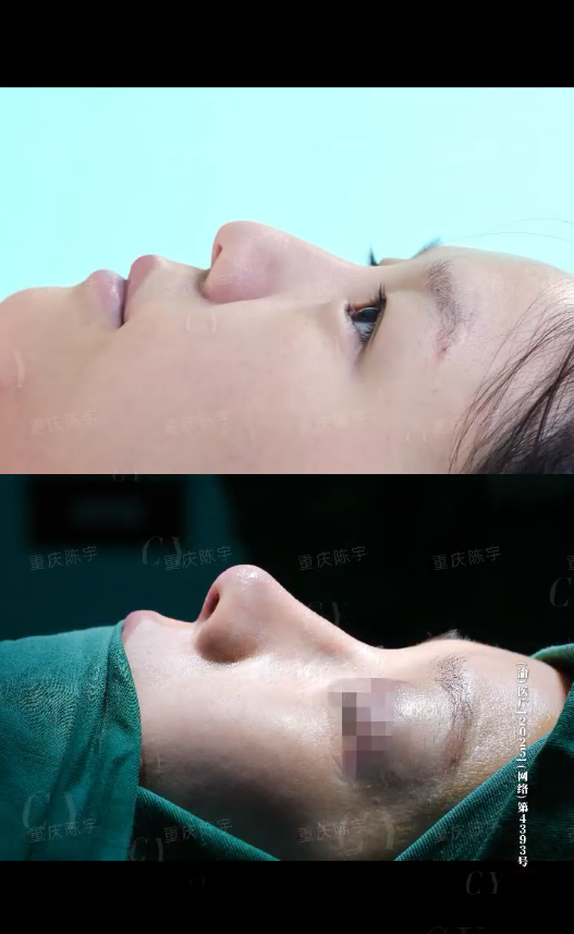 膨体肋骨鼻修复