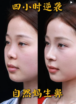 宁波龚涛院长同款妈生直鼻微翘