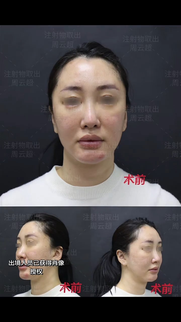 下巴生长因子取出 本身有荨麻疹是不是会过
