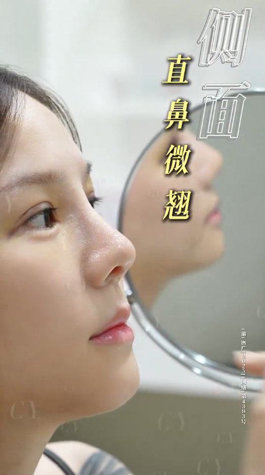 👃膨体肋骨鼻修复｜术后10天拆线