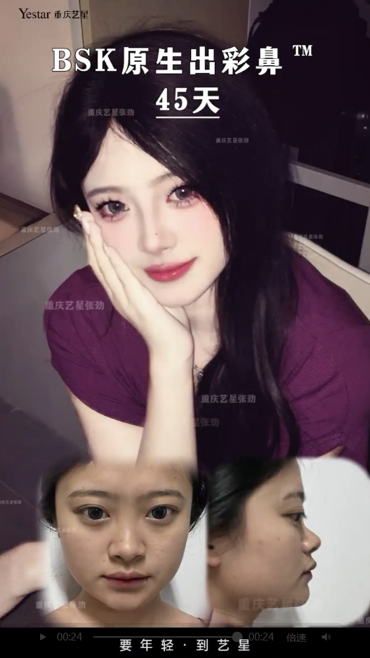 妈生肋骨鼻术后真实反馈💫