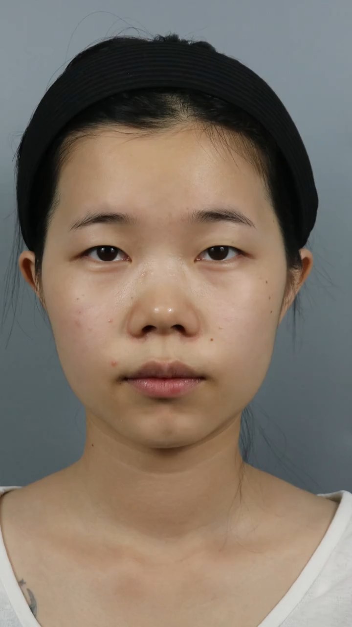 双眼皮适合自己很重要。