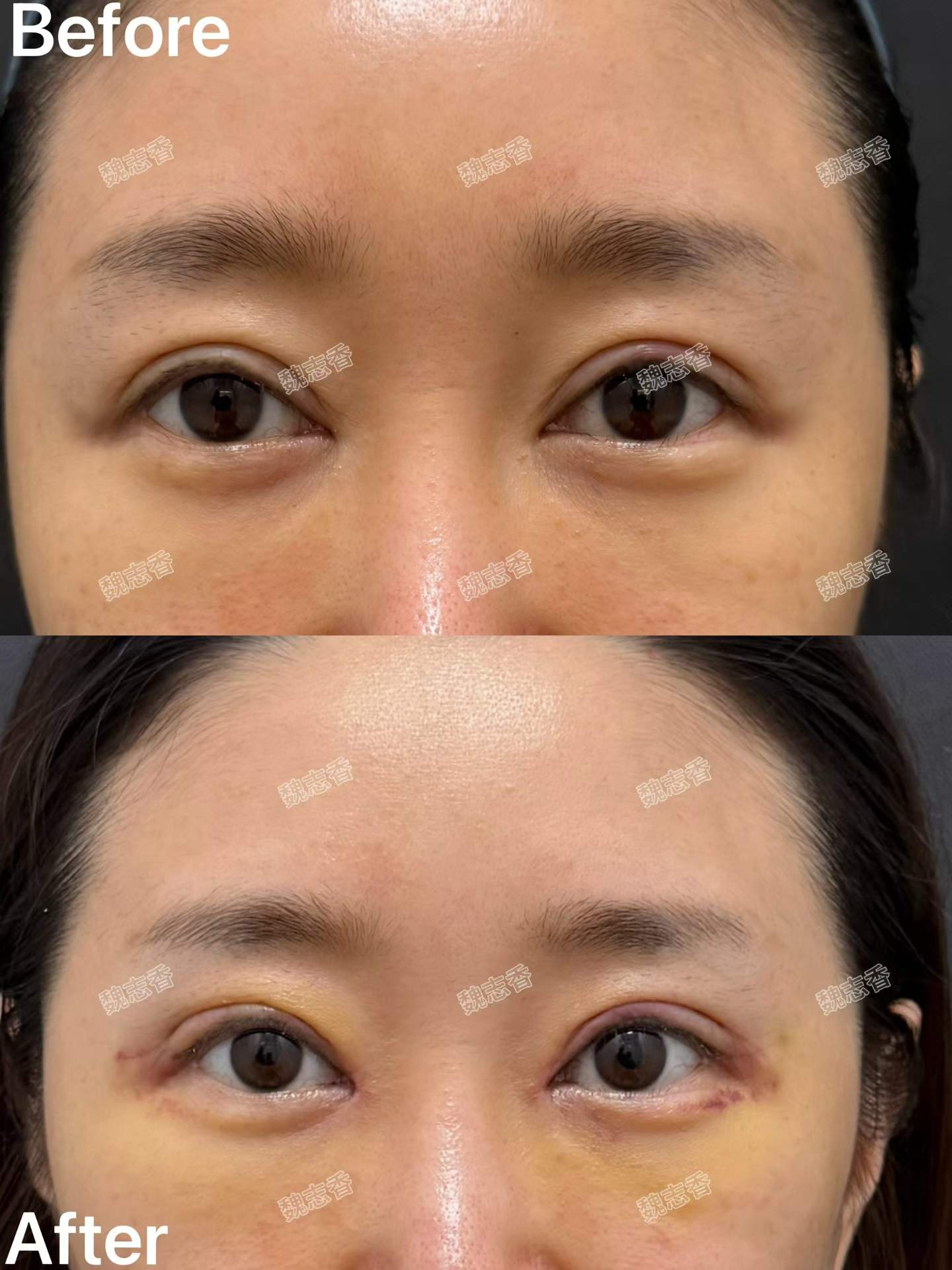 双眼皮修复➕内眼角修复术后七天 1
