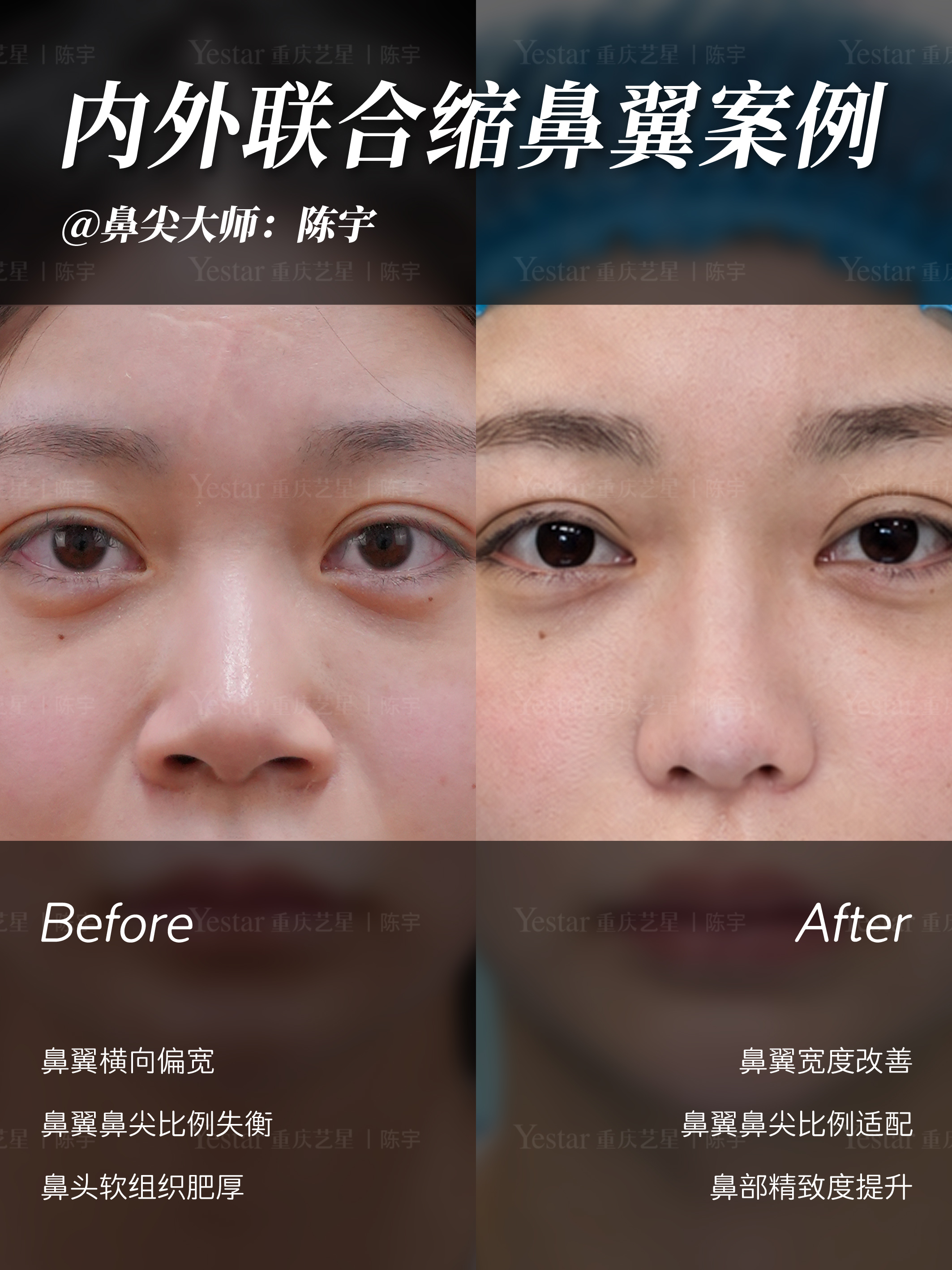 ✨内外联合缩鼻翼 3