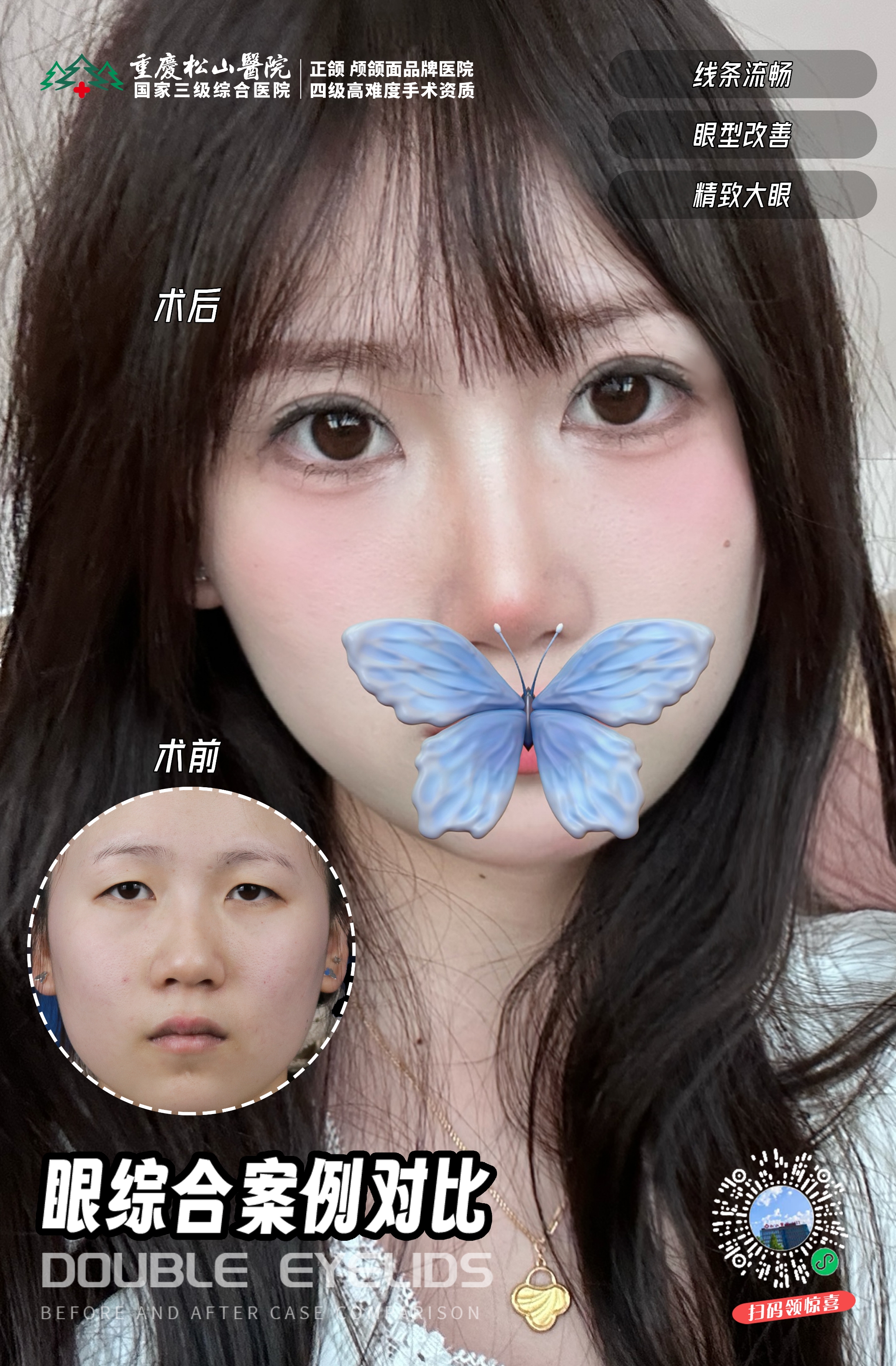 眼综合案例对比 1