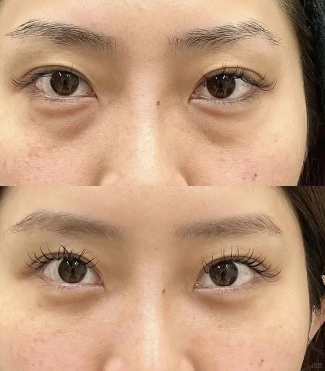 眼袋泪沟消失后，素颜都自带精致感✨
