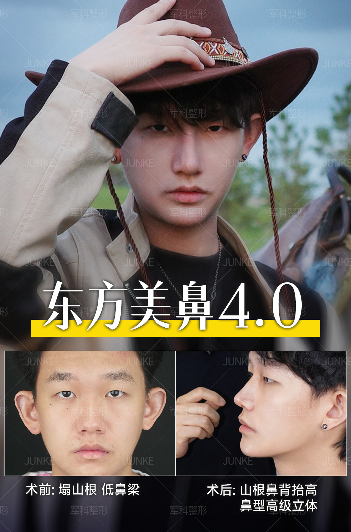 隆鼻算是男生变帅邪修嘛🌟 1