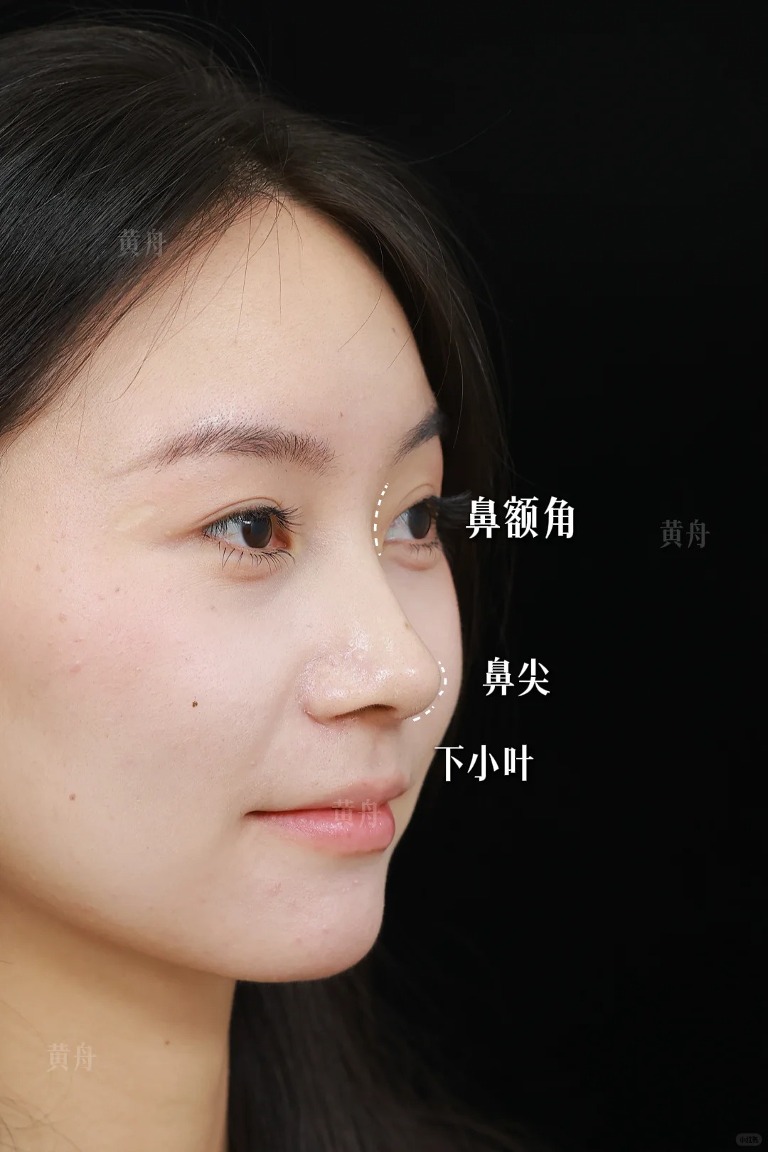 低山根妈生鼻，定制化贴合五官 1