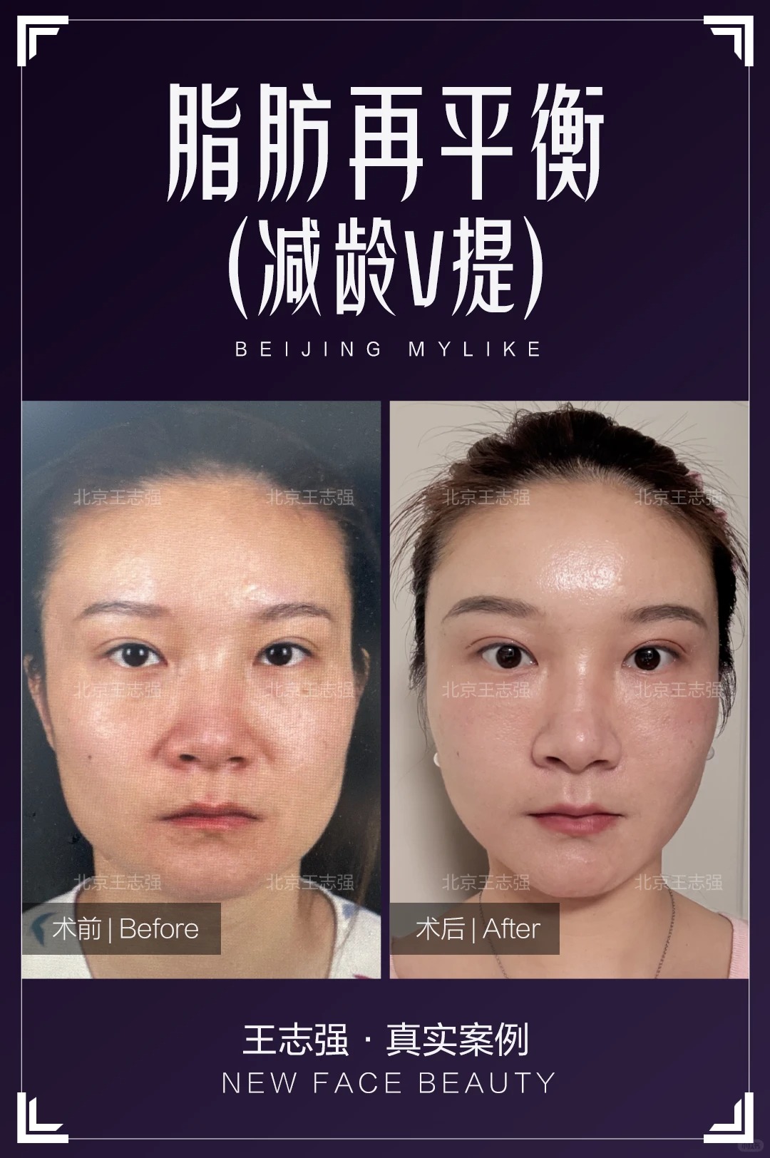 减龄V提 1