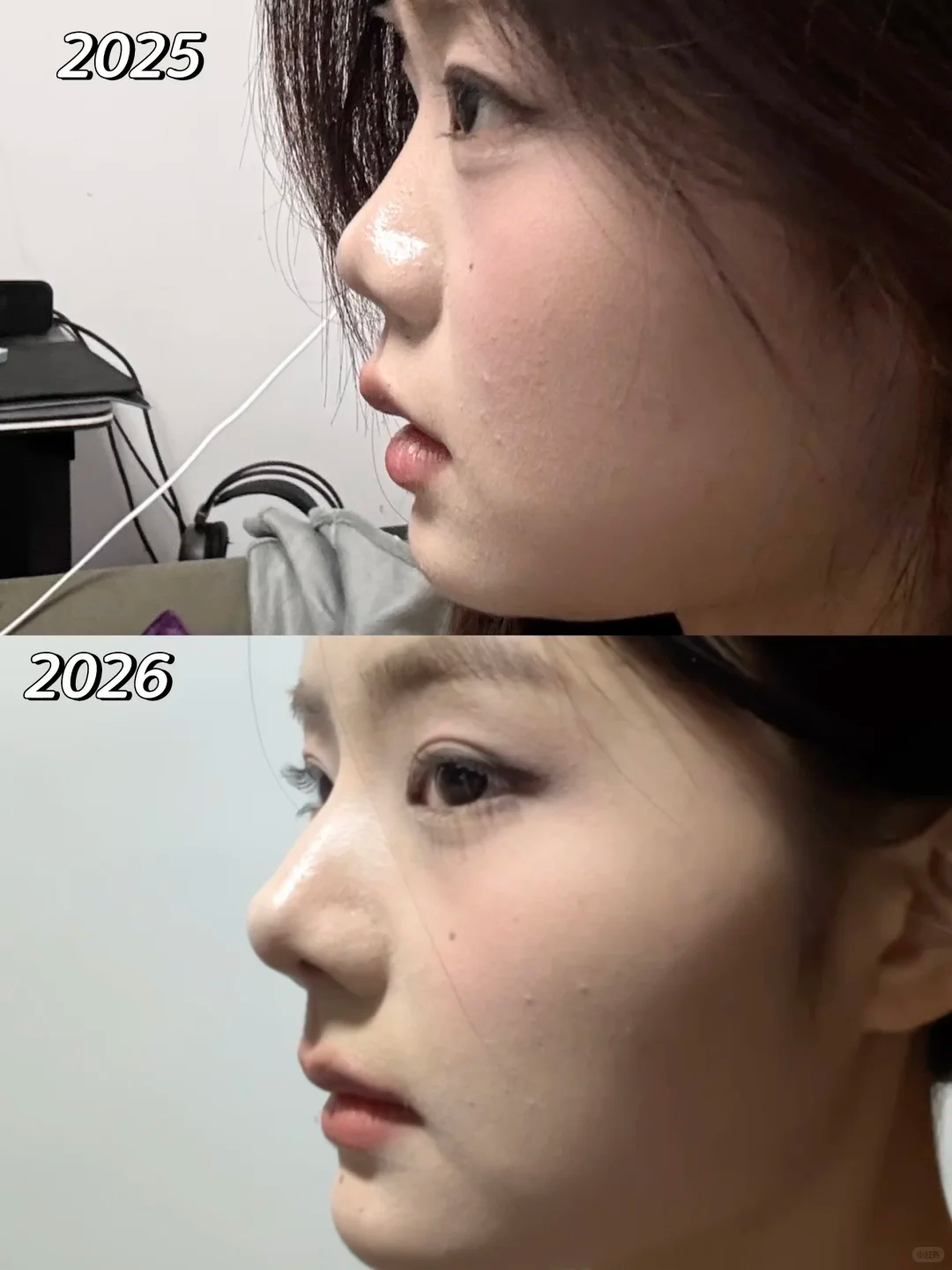 do完鼻子真的不一样 1