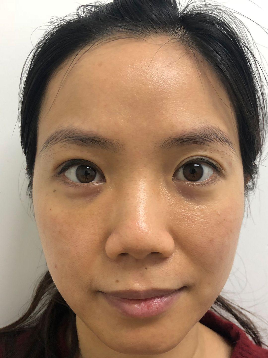 上睑下垂矫正恢复记录。 5