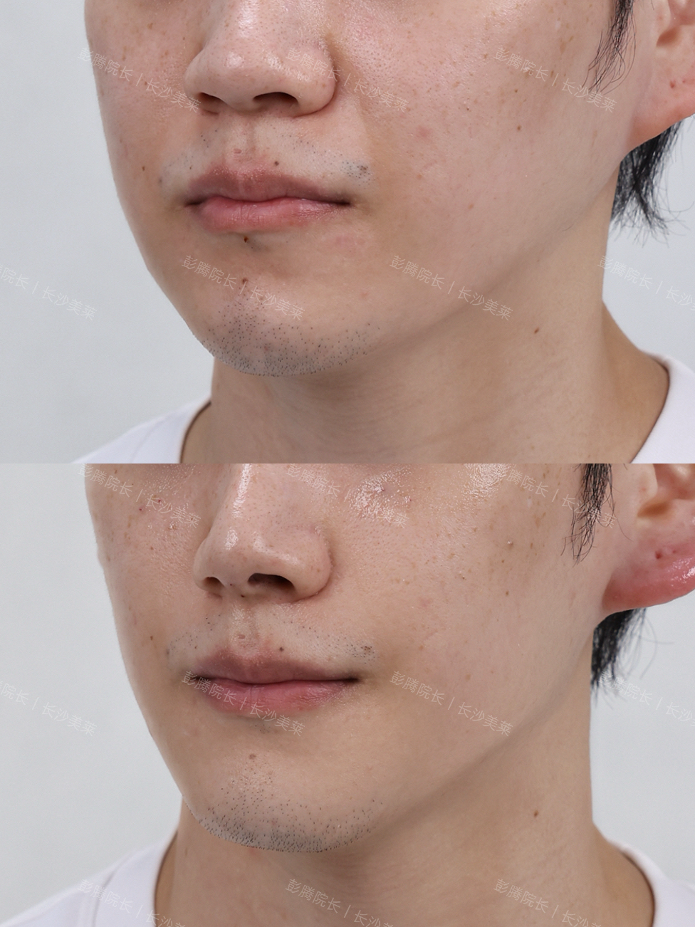 男生骨相微调 5