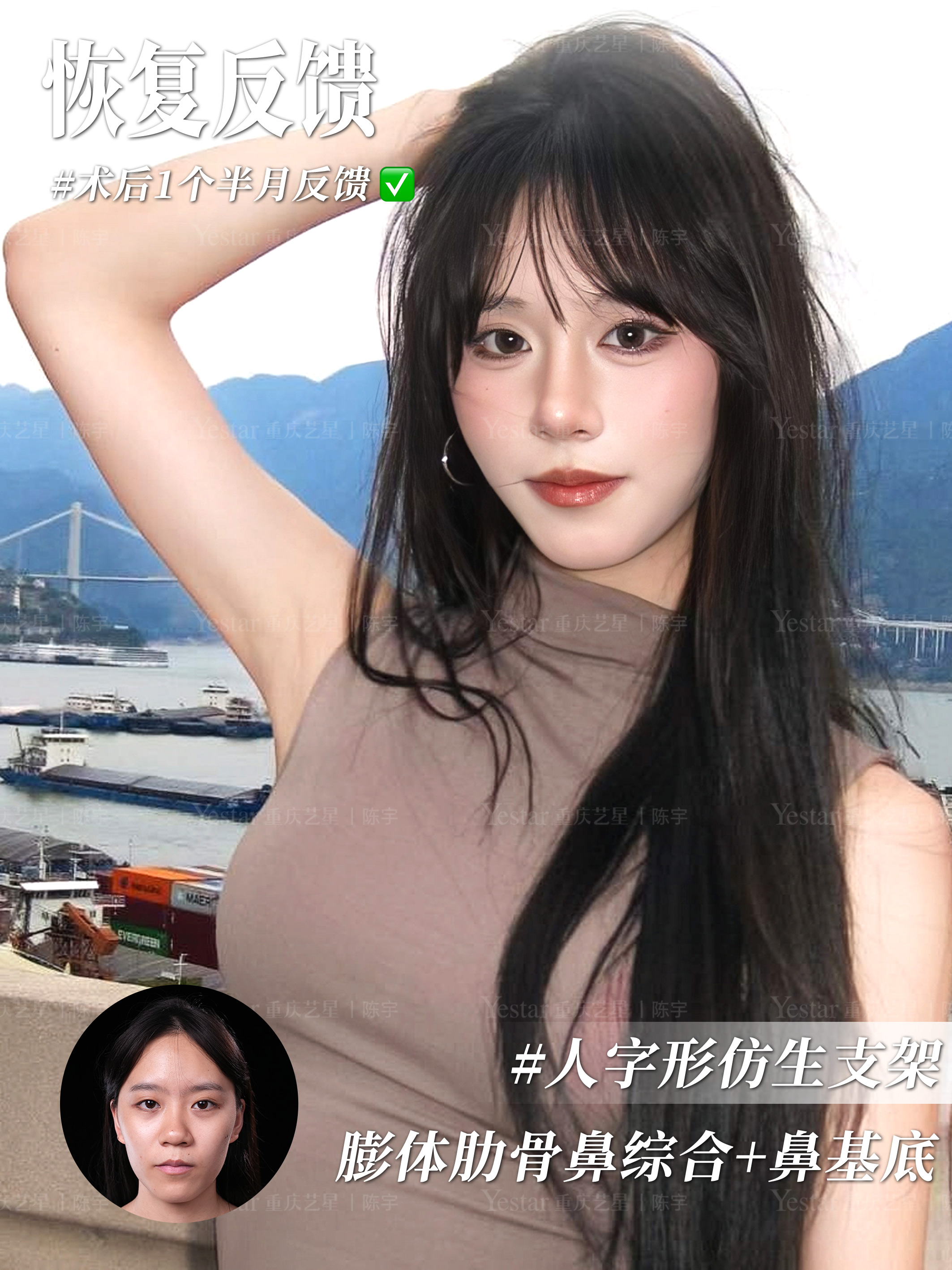 膨体肋骨鼻恢复过程记录📝 1