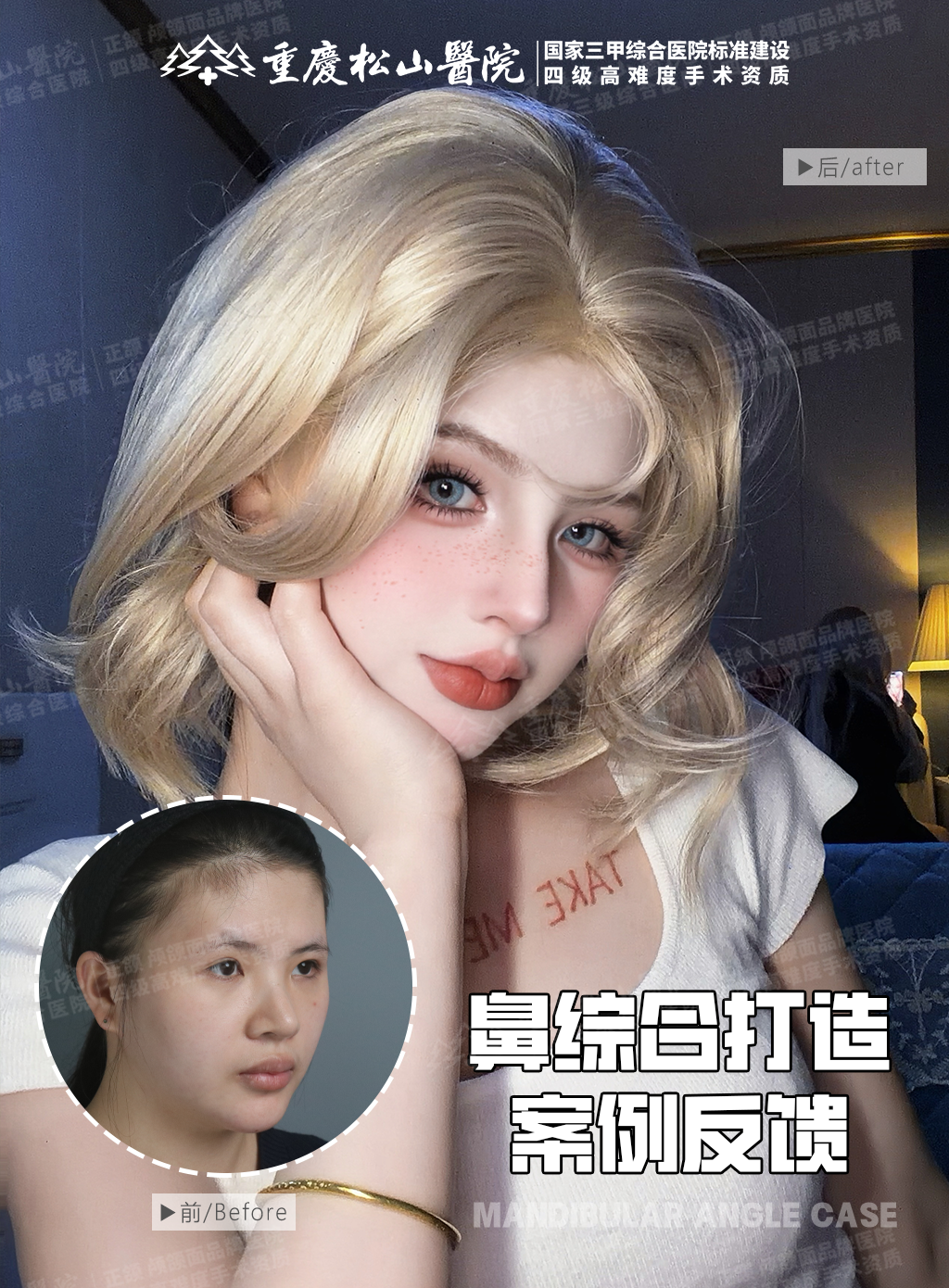 鼻综合打造 1