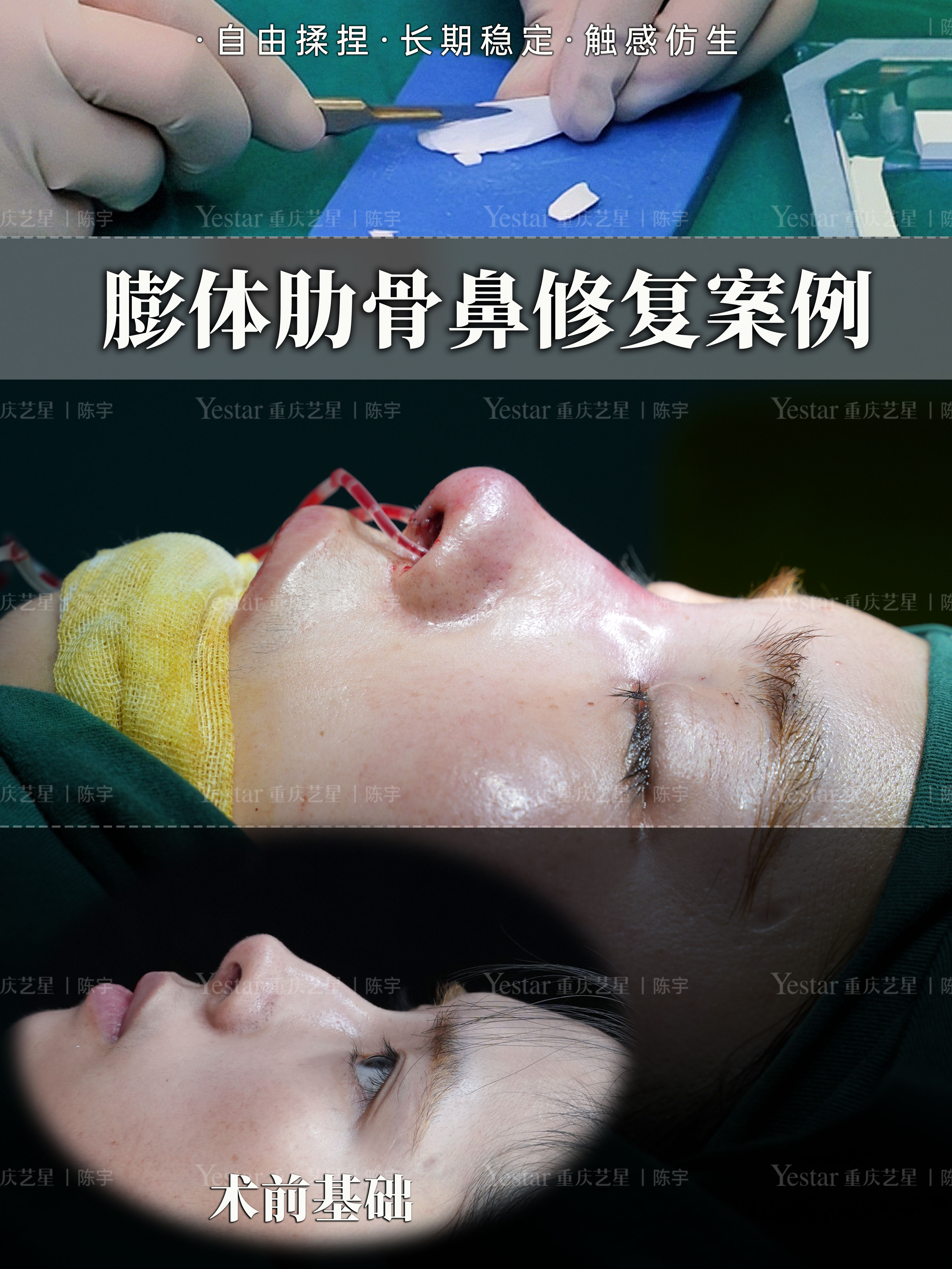 膨体肋骨鼻修复👃 1