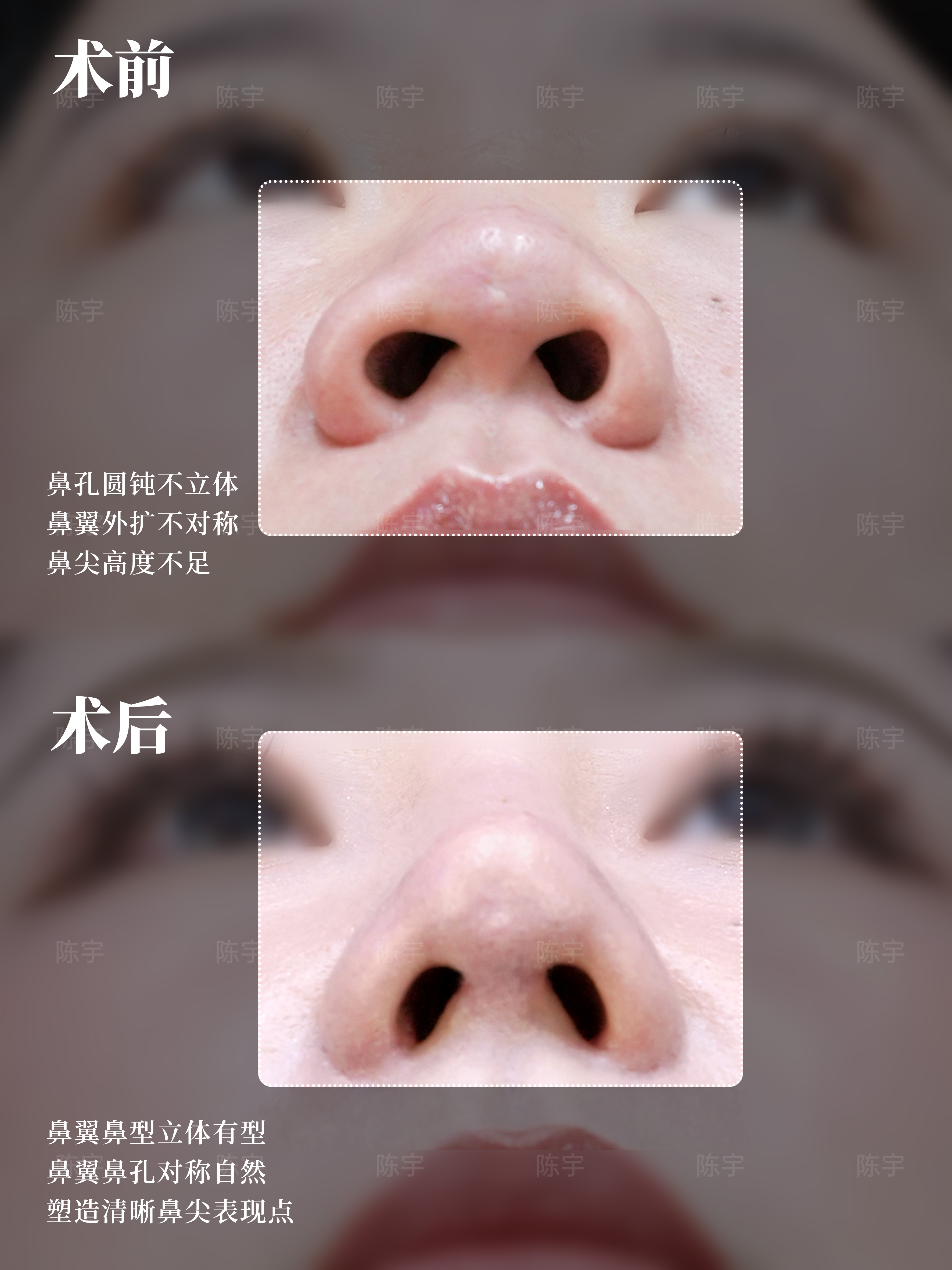 蒜头鼻 鼻综合改善👃 3